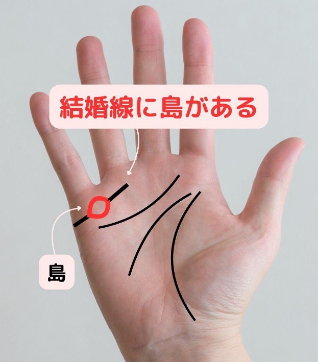 結婚線に島がある